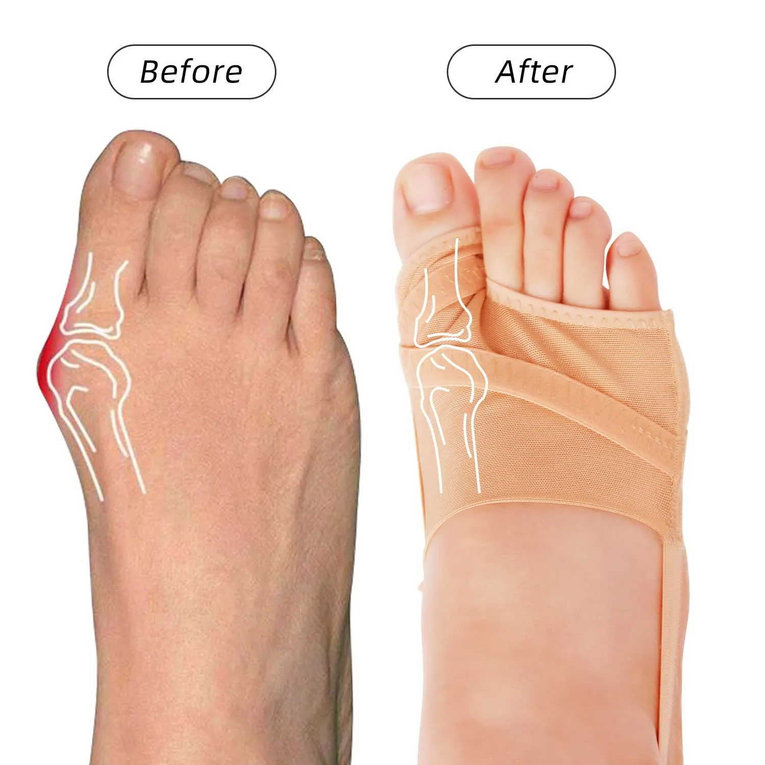 Bunion Corrector Big Toe Separator Pain Relief Orthopedic Bunion Splint